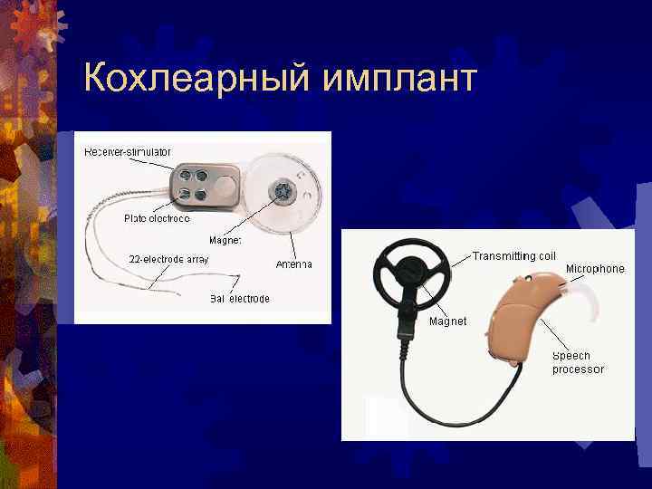 Кохлеарный имплант 
