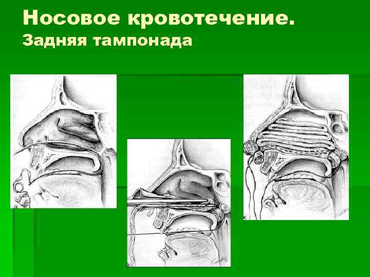 Носовое кровотечение. Задняя тампонада 