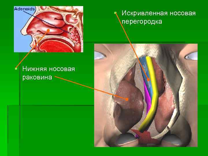 § Искривленная носовая перегородка § Нижняя носовая раковина 