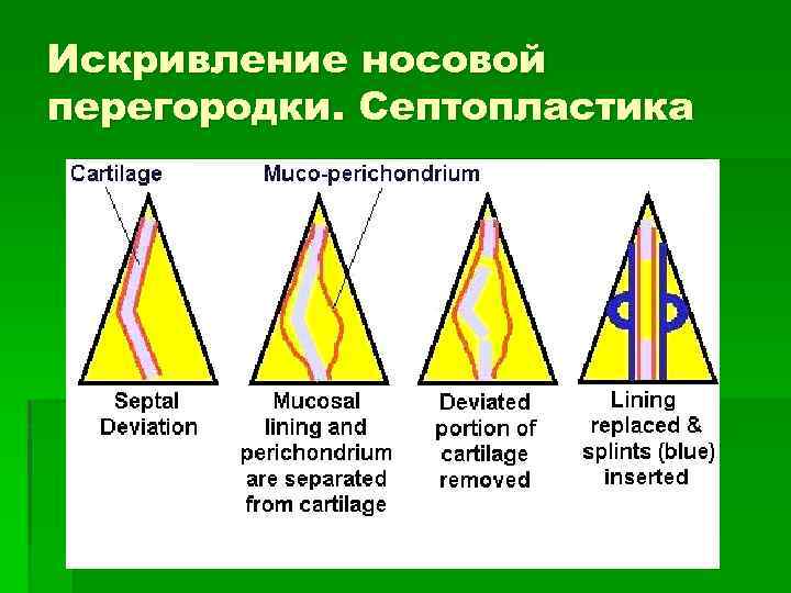 Искривление носовой перегородки. Септопластика 