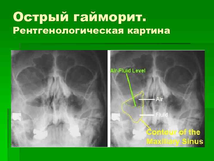 Острый гайморит. Рентгенологическая картина 