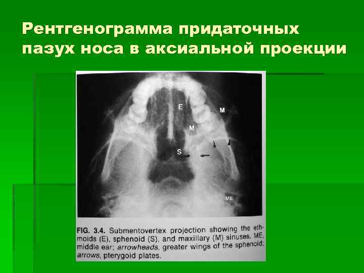 Рентгенограмма придаточных пазух носа в аксиальной проекции 