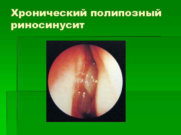 Хронический полипозный риносинусит 