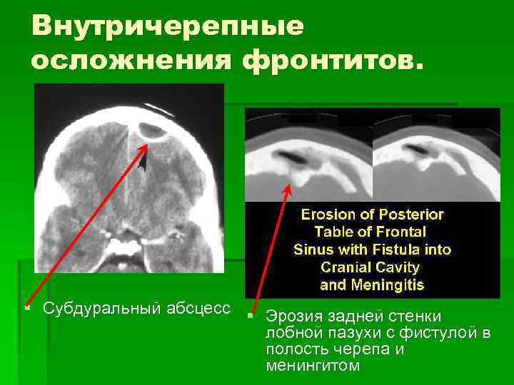 Внутричерепные осложнения фронтитов. § Субдуральный абсцесс § Эрозия задней стенки лобной пазухи с фистулой