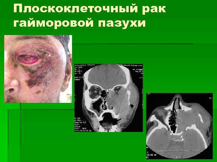 Плоскоклеточный рак гайморовой пазухи 