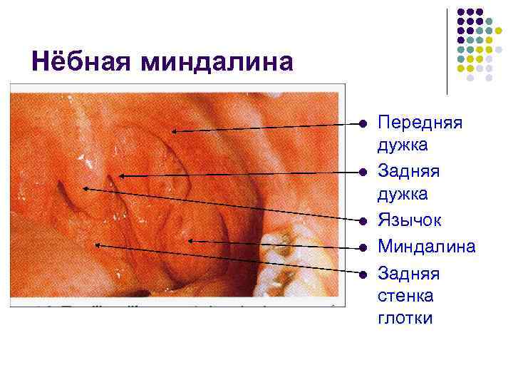 Нёбная миндалина l l l Передняя дужка Задняя дужка Язычок Миндалина Задняя стенка глотки