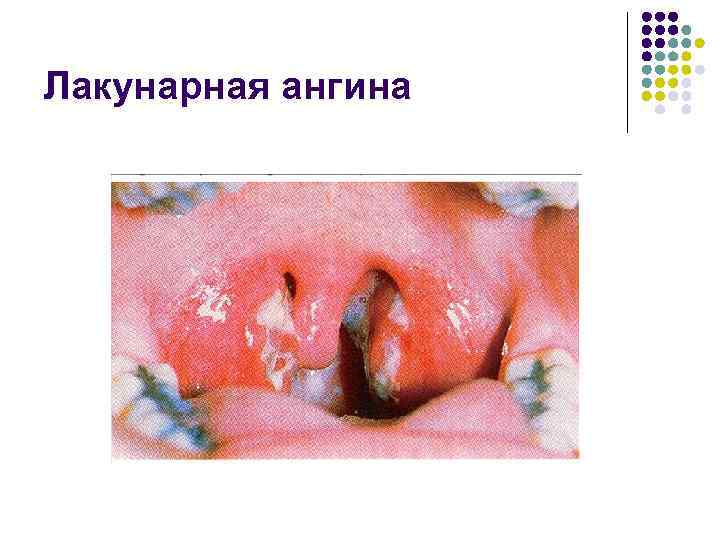 Лакунарная ангина 