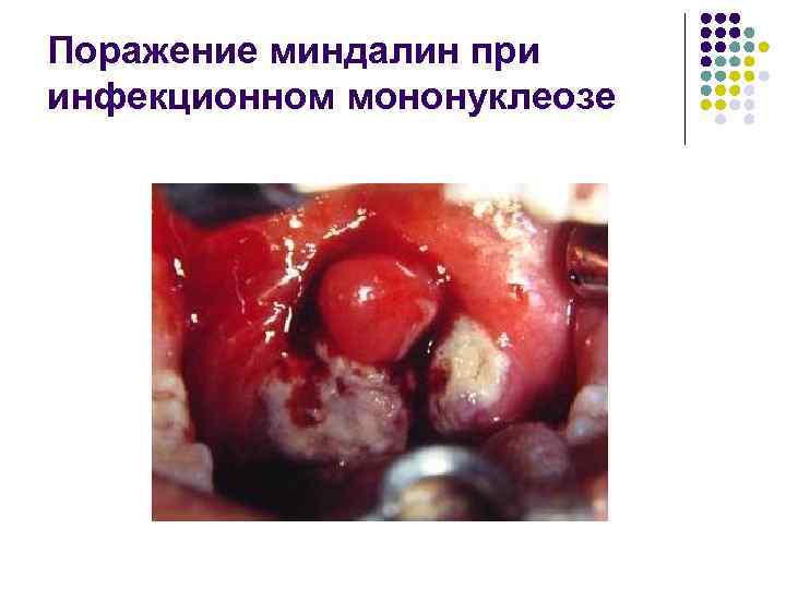 Поражение миндалин при инфекционном мононуклеозе 