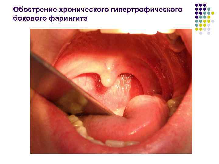 Обострение хронического гипертрофического бокового фарингита 