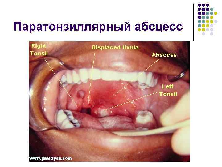 Паратонзиллярный абсцесс 