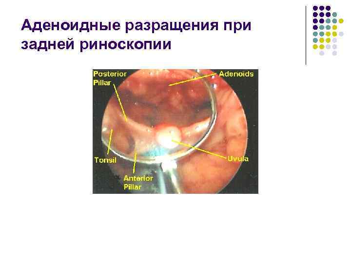 Аденоидные разращения при задней риноскопии 