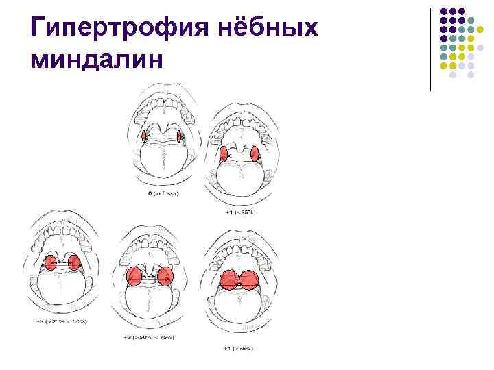 Гипертрофия нёбных миндалин 
