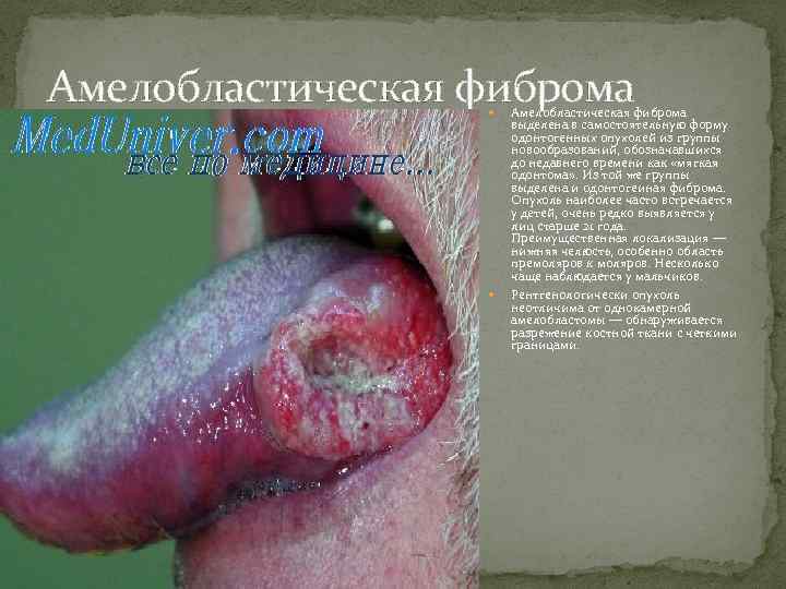 Амелобластическая фиброма выделена в самостоятельную форму одонтогенных опухолей из группы новообразований, обозначавшихся до недавнего