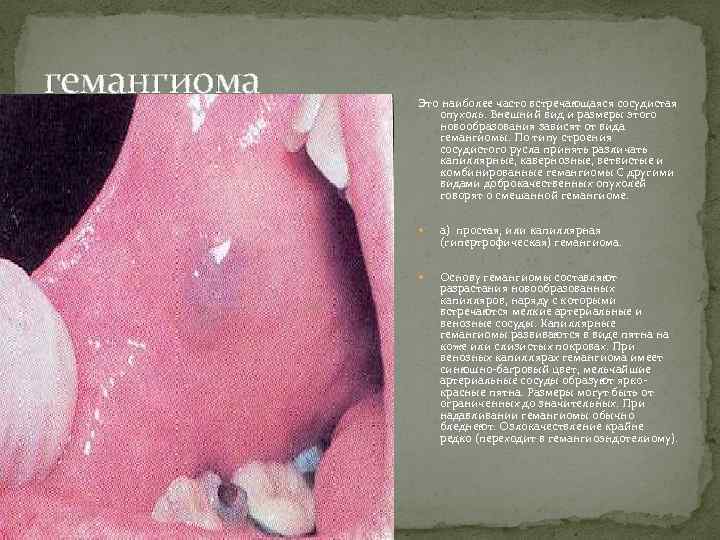 гемангиома Это наиболее часто встречающаяся сосудистая опухоль. Внешний вид и размеры этого новообразования зависят
