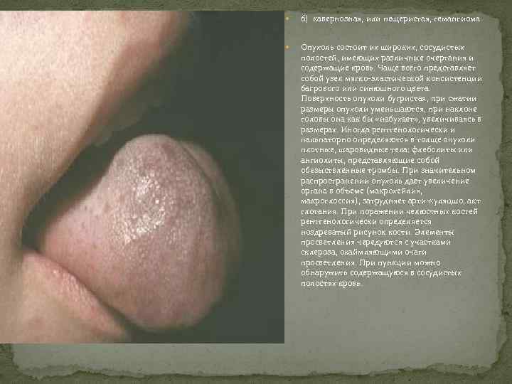  б) кавернозная, или пещеристая, гемангиома. Опухоль состоит их широких, сосудистых полостей, имеющих различные
