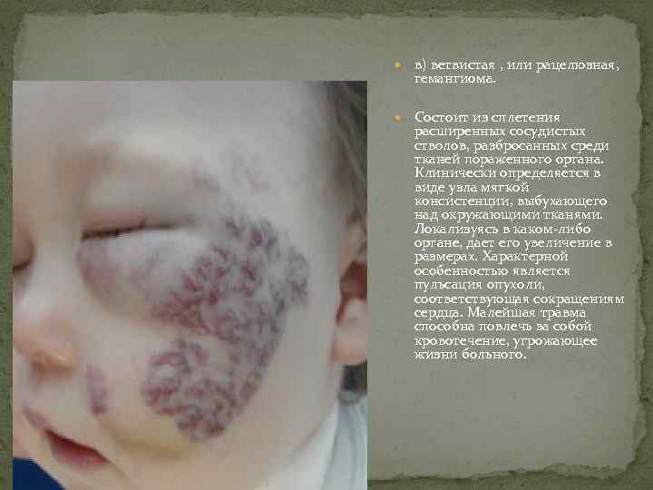  в) ветвистая , или рацелюзная, гемангиома. Состоит из сплетения расширенных сосудистых стволов, разбросанных