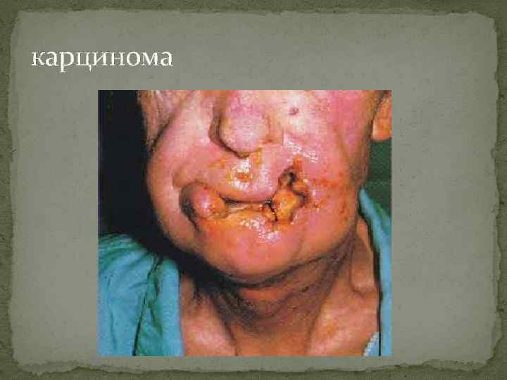 карцинома 