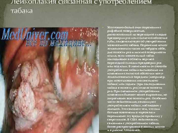 Лейкоплакия связанная с употреблением табака Желтовато-белый очаг поражения с рифлёной поверхностью, расположенный на переходной
