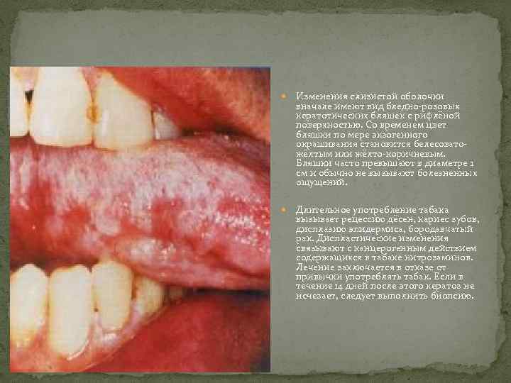  Изменения слизистой оболочки вначале имеют вид бледно-розовых кератотических бляшек с рифлёной поверхностью. Со