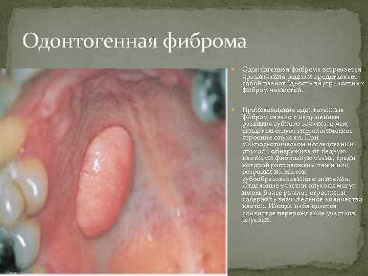 Одонтогенная фиброма встречается чрезвычайно редко и представляет собой разновидность внутрикостных фибром челюстей. Происхождение одонтогенных