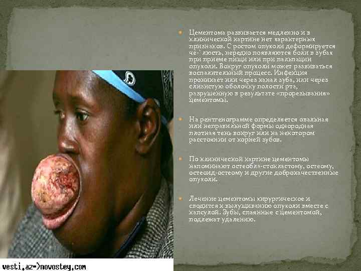  Цементома развивается медленно и в клинической картине нет характерных признаков. С ростом опухоли