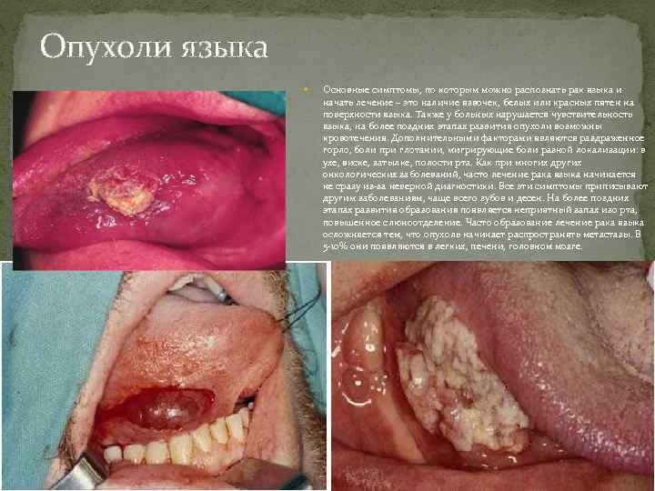 Опухоли языка Основные симптомы, по которым можно распознать рак языка и начать лечение –