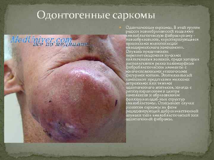 Одонтогенные саркомы Одонтогенные саркомы. В этой группе редких новообразований выделяют амелобластическую фибросаркому новообразование, характеризующееся