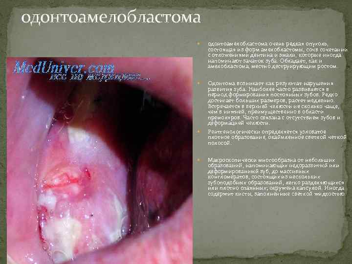 одонтоамелобластома очень редкая опухоль, состоящая из форм амелобластомы, сочв сочетании с отложениями дентина и