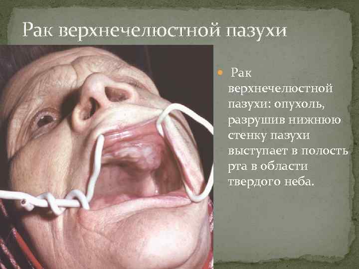 Рак верхнечелюстной пазухи Рак верхнечелюстной пазухи: опухоль, разрушив нижнюю стенку пазухи выступает в полость