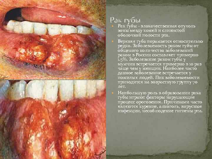 Рак губы - злокачественная опухоль зоны мезду кожей и слизистой оболочкой полости рта. Верхняя