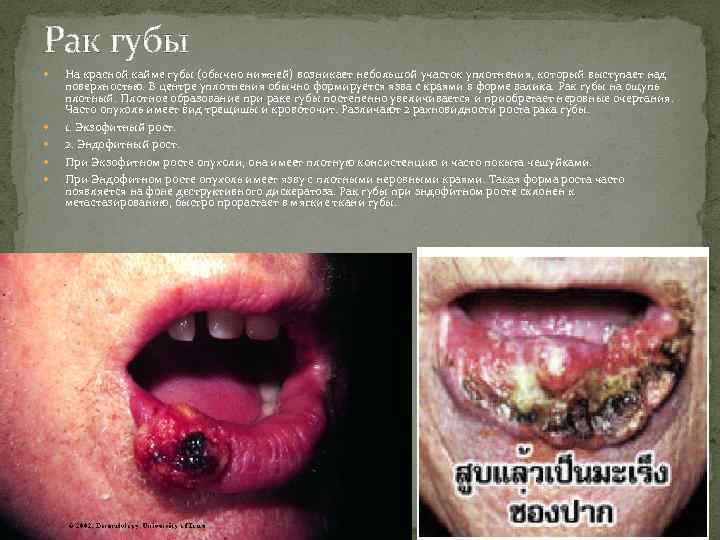 Рак губы На красной кайме губы (обычно нижней) возникает небольшой участок уплотнения, который выступает