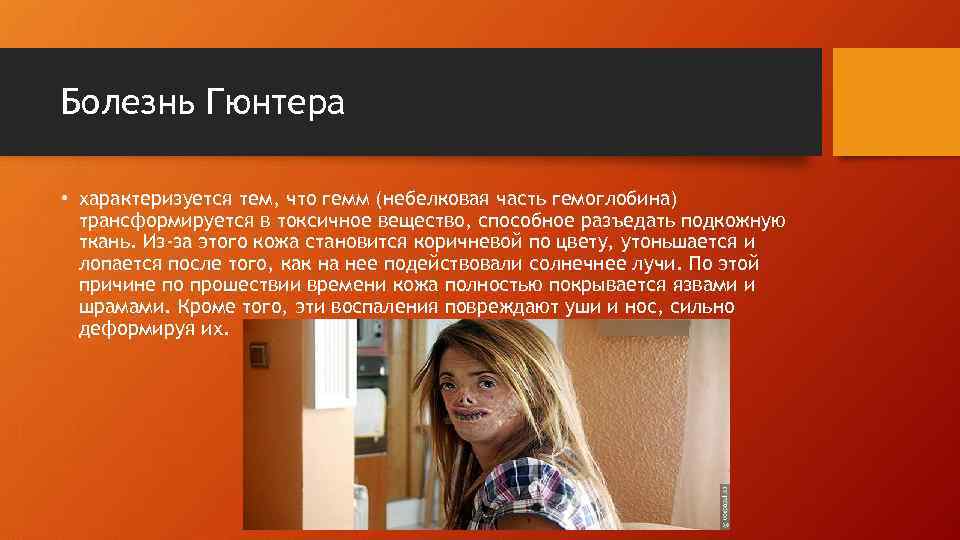 Болезнь Гюнтера • характеризуется тем, что гемм (небелковая часть гемоглобина) трансформируется в токсичное вещество,