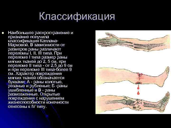 Классификация l Наибольшее распространение и признание получила классификация Каплана. Марковой. В зависимости от размеров