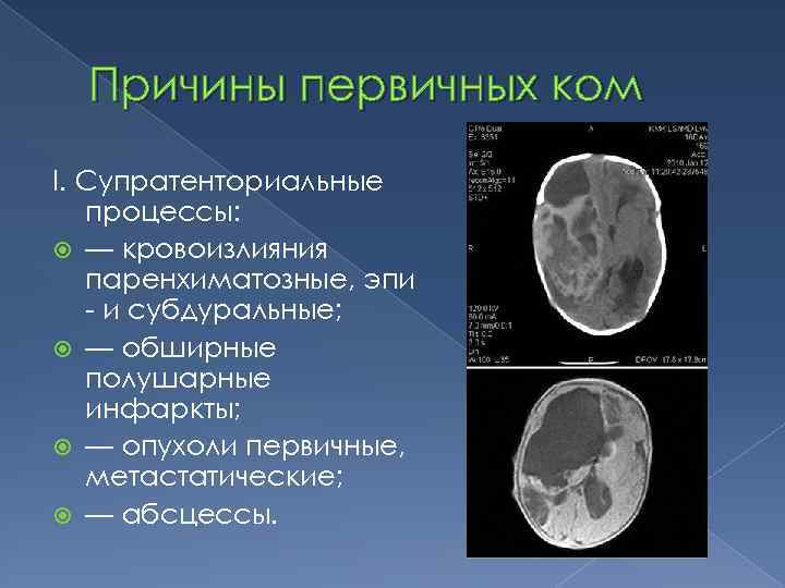 Причины первичных ком I. Супратенториальные процессы: — кровоизлияния паренхиматозные, эпи - и субдуральные; —