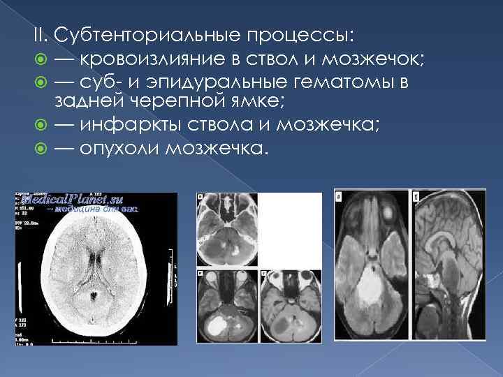 II. Субтенториальные процессы: — кровоизлияние в ствол и мозжечок; — суб- и эпидуральные гематомы