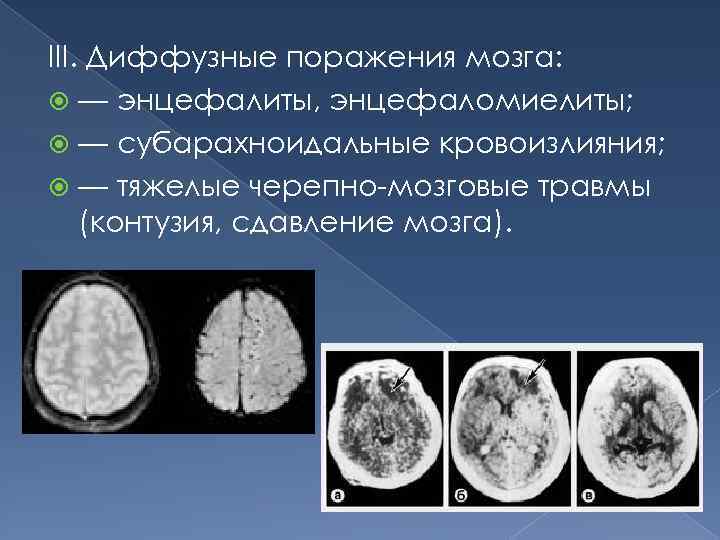 III. Диффузные поражения мозга: — энцефалиты, энцефаломиелиты; — субарахноидальные кровоизлияния; — тяжелые черепно-мозговые травмы