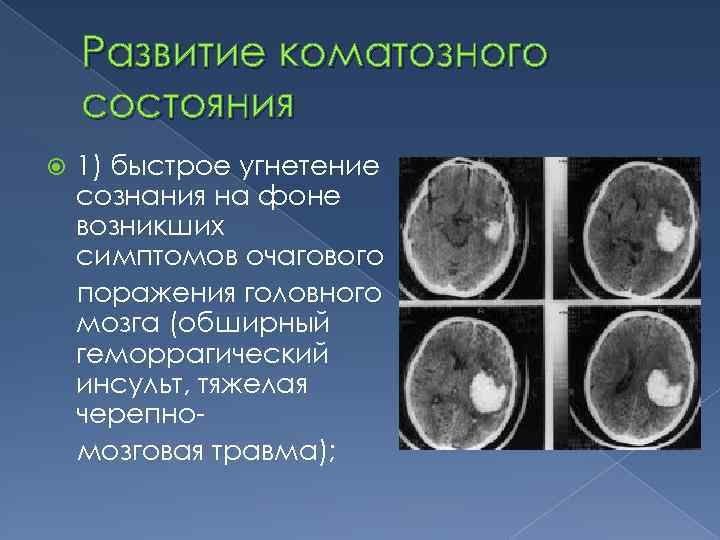 Развитие коматозного состояния 1) быстрое угнетение сознания на фоне возникших симптомов очагового поражения головного