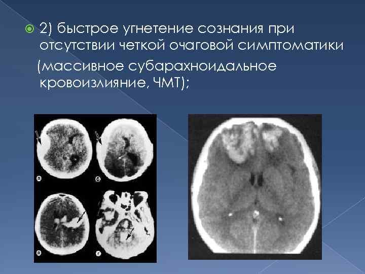  2) быстрое угнетение сознания при отсутствии четкой очаговой симптоматики (массивное субарахноидальное кровоизлияние, ЧМТ);