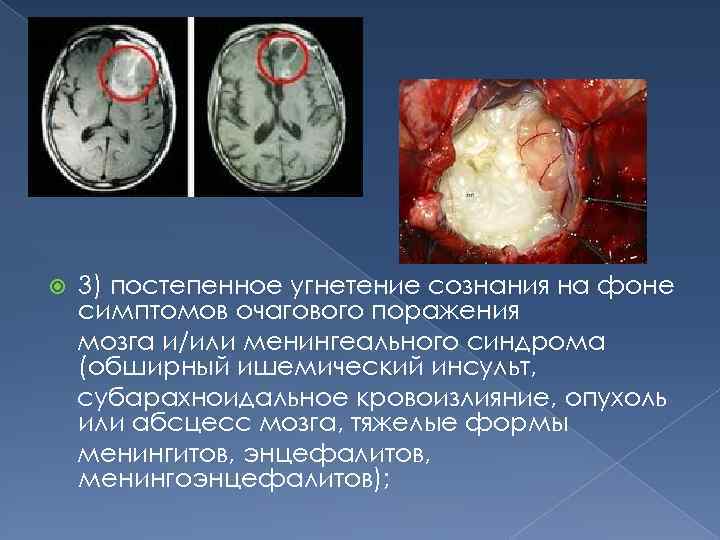  3) постепенное угнетение сознания на фоне симптомов очагового поражения мозга и/или менингеального синдрома