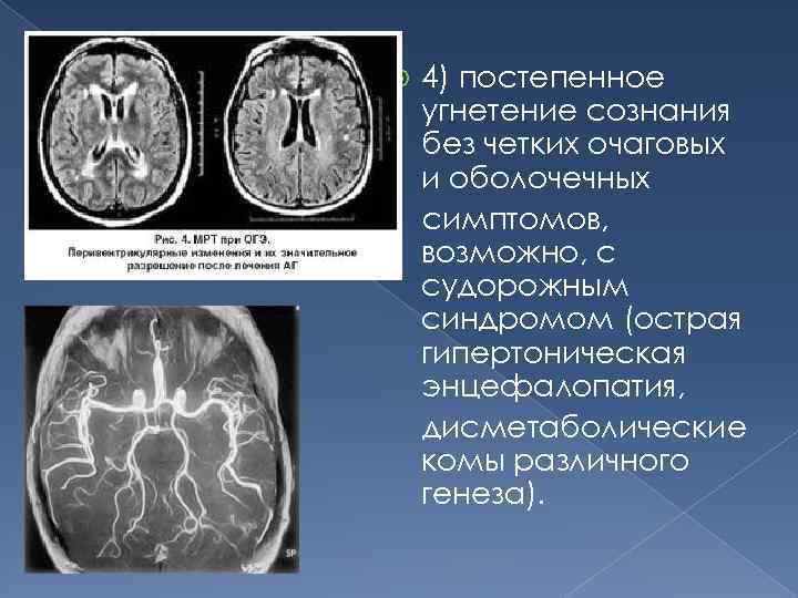  4) постепенное угнетение сознания без четких очаговых и оболочечных симптомов, возможно, с судорожным