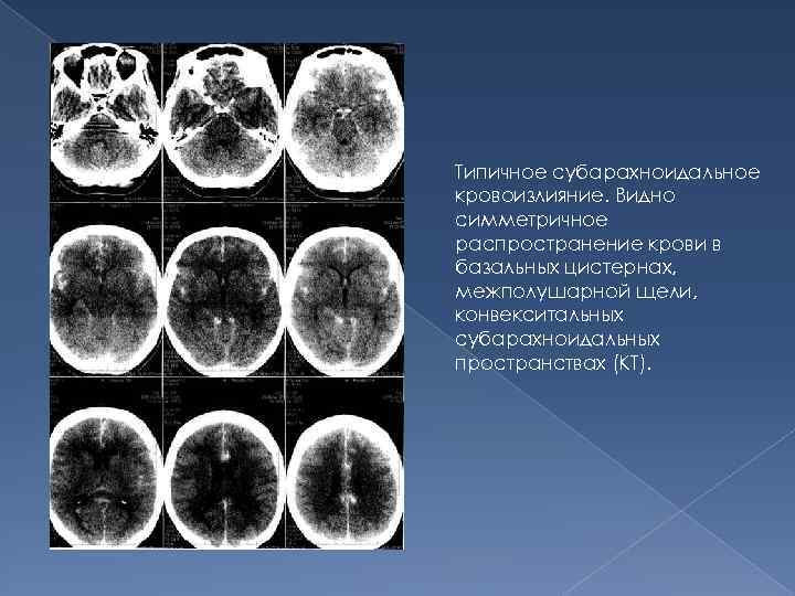 Типичное субарахноидальное кровоизлияние. Видно симметричное распространение крови в базальных цистернах, межполушарной щели, конвекситальных субарахноидальных