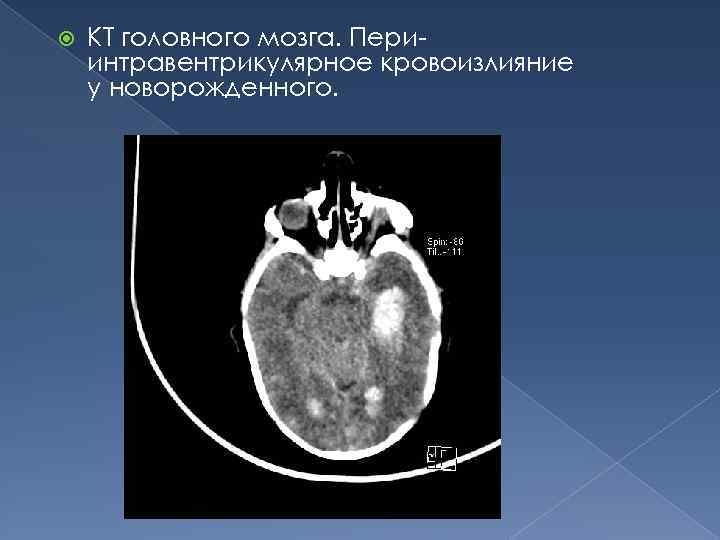  КТ головного мозга. Периинтравентрикулярное кровоизлияние у новорожденного. 