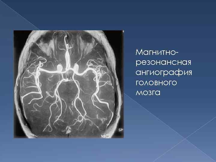 Магнитнорезонансная ангиография головного мозга 