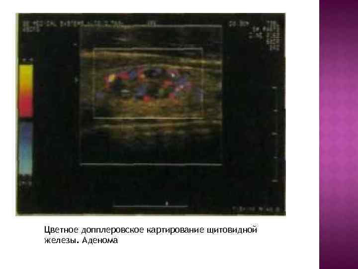 Цветное допплеровское картирование щитовидной железы. Аденома 