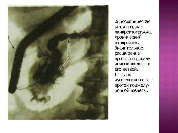 Эндоскопическая ретроградная панкреатограмма. Хронический панкреатит. Значительное расширение протока поджелудочной железы и его ветвей. I