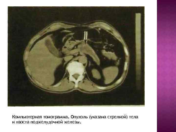 Компьютерная томограмма. Опухоль (указана стрелкой) тела и хвоста поджелудочной железы. 