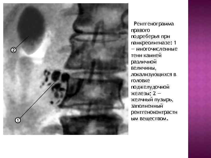  Рентгенограмма правого подреберья при панкреолитиазе: 1 — многочисленные тени камней различной величины, локализующихся