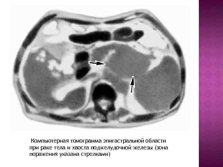  Компьютерная томограмма эпигастральной области при раке тела и хвоста поджелудочной железы (зона поражения