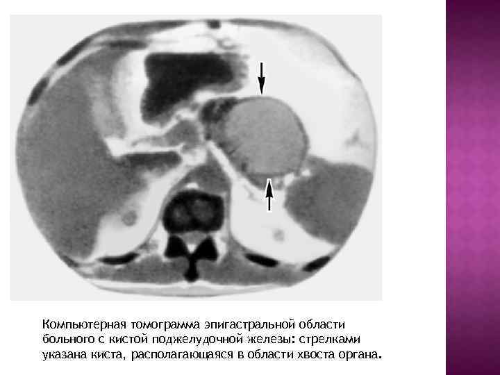 Компьютерная томограмма эпигастральной области больного с кистой поджелудочной железы: стрелками указана киста, располагающаяся в