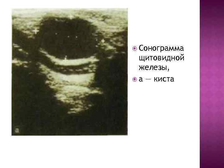  Сонограмма щитовидной железы, а — киста 